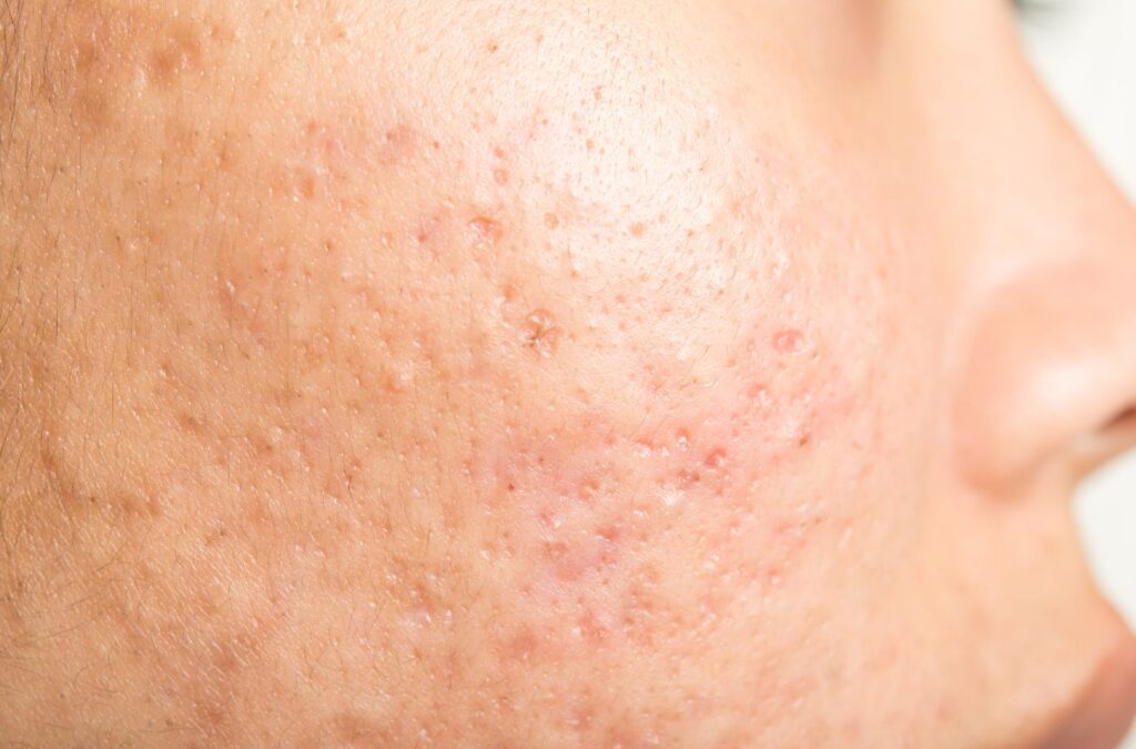 Acne scars