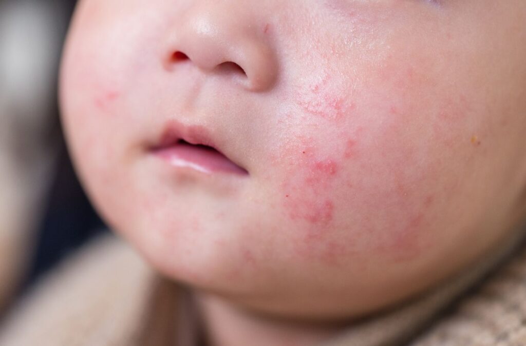 Eczema (একজিমা)