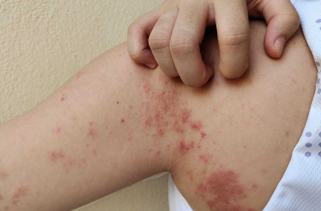 Impetigo (চর্ম রোগের জীবাণু):