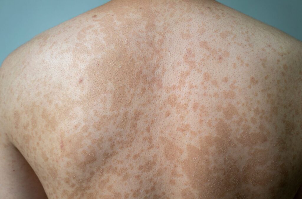 Pityriasis Versicolor (ফুলকী)