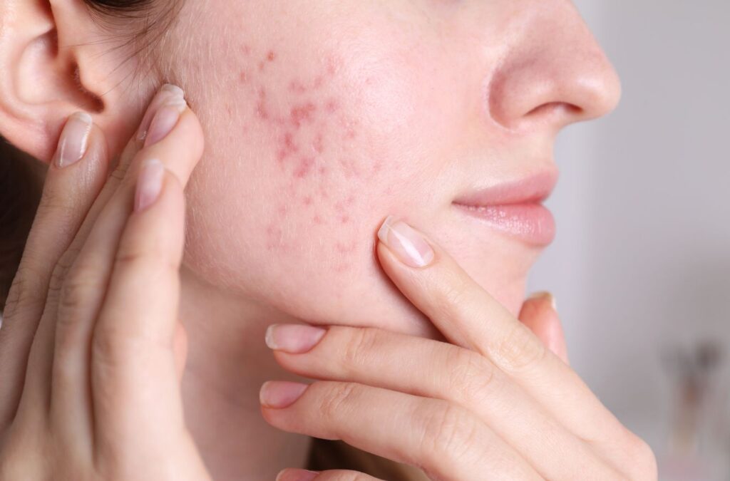 Post acne hyperpigmentation