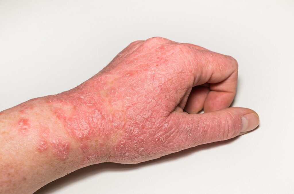 Psoriasis