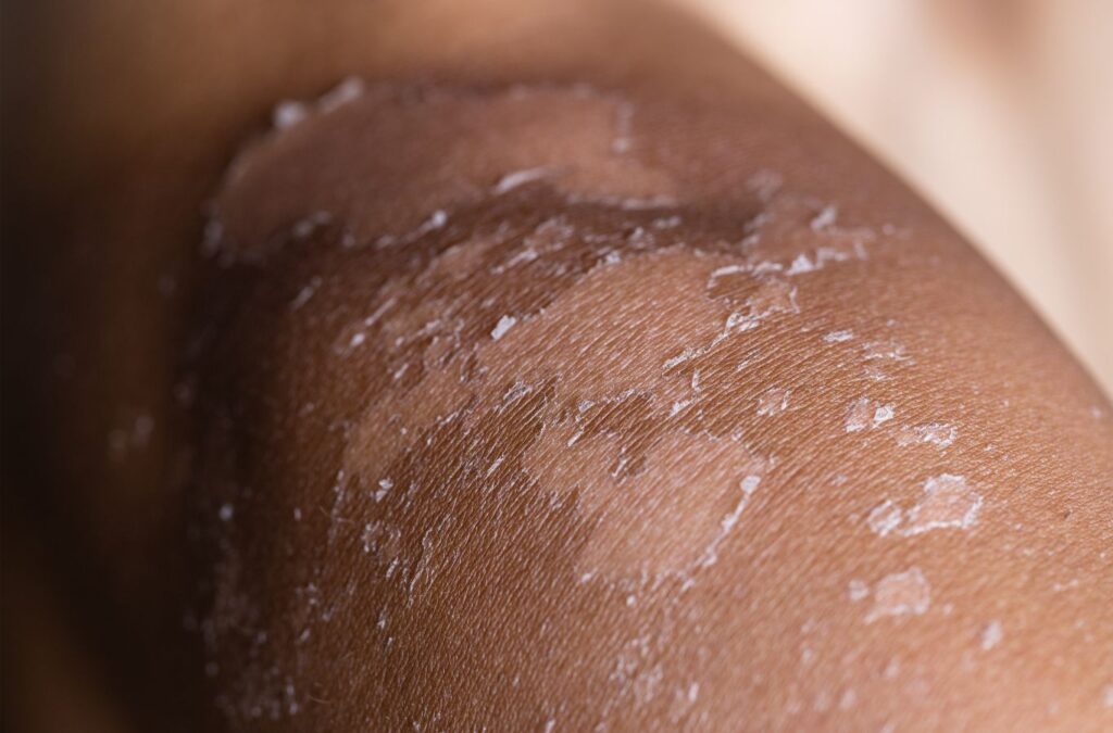 Suntan removal (রোদে পোড়া দাগের চিকিৎসা)
